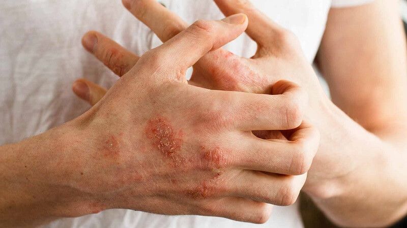 Red, Scaly, Itchy Psoriasis