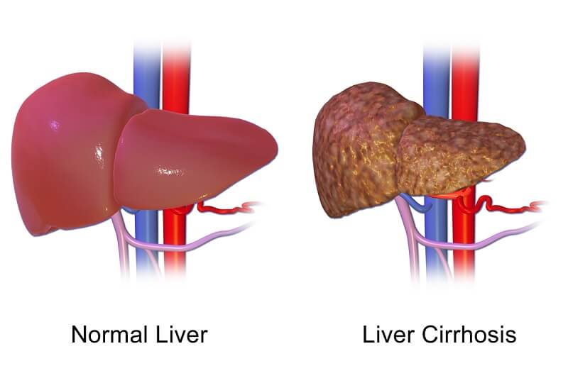 Liver cirrhosis is a severe liver disease