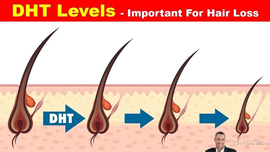 DHT hair loss stages