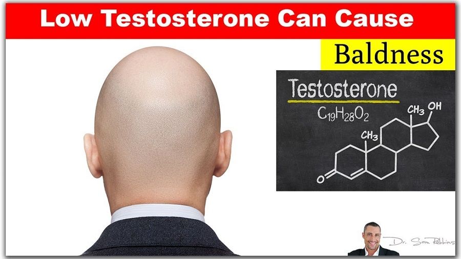 Male pattern baldness-improve your DHT levels and help your hair loss issue