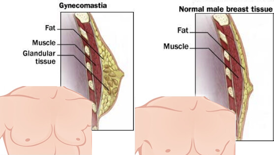 Gynecomastia - Manboobs/Bitch tits- before and after pic