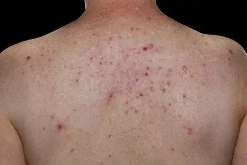 acne- side effects caused by dianabol