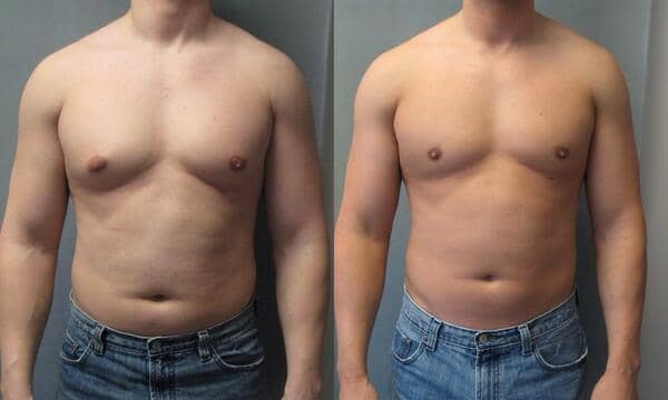chest fat results